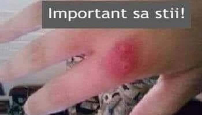 Urgențe de sezon! Cum deosebești înțepăturile de insecte